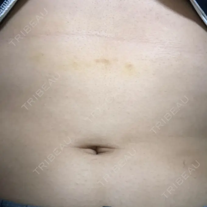 その他（ボディ） 船橋中央クリニック DAY 5 メイン用