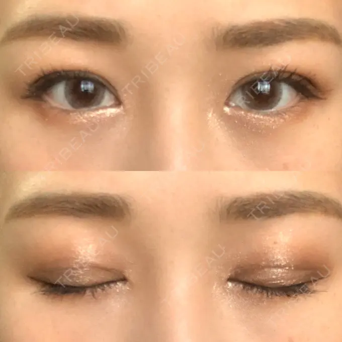 二重埋没 湘南美容クリニック 西宮北口院 DAY 17 メイン用