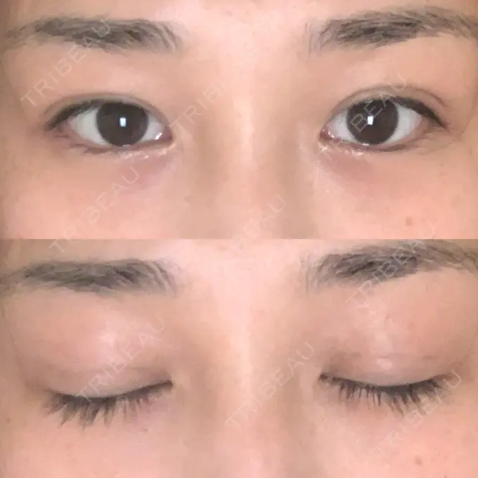 二重埋没 湘南美容クリニック 西宮北口院 DAY 20 メイン用