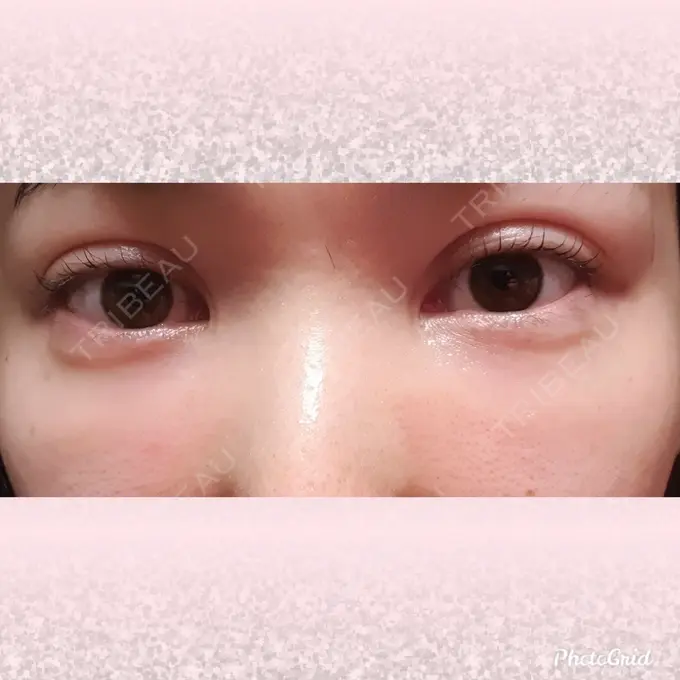 シワ取りボトックス CLASSY 仙台美容外科・美容皮膚科 DAY 11 メイン用