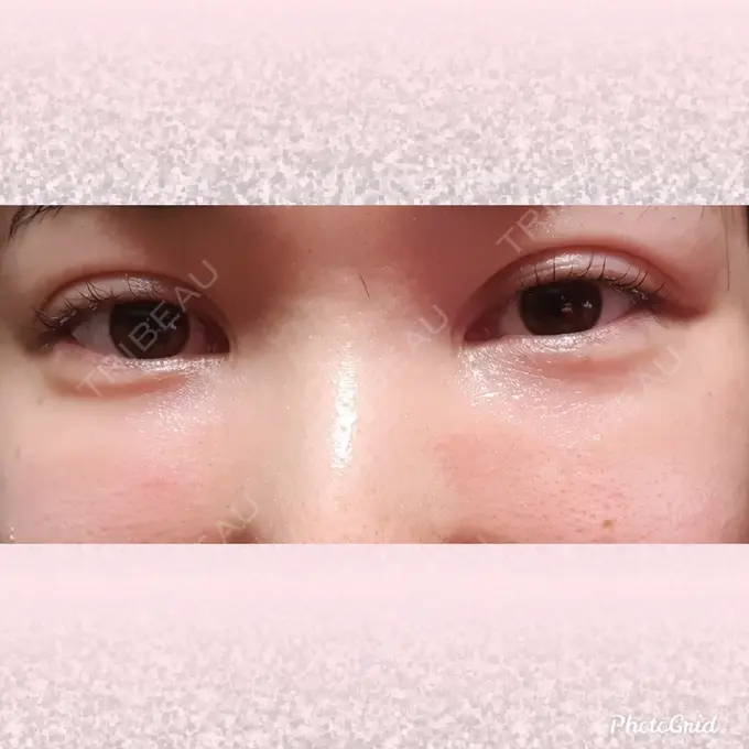 シワ取りボトックス CLASSY 仙台美容外科・美容皮膚科 DAY 11 メイン用