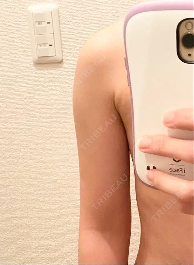 脂肪吸引（二の腕） 広島プルミエクリニック DAY 74 メイン用