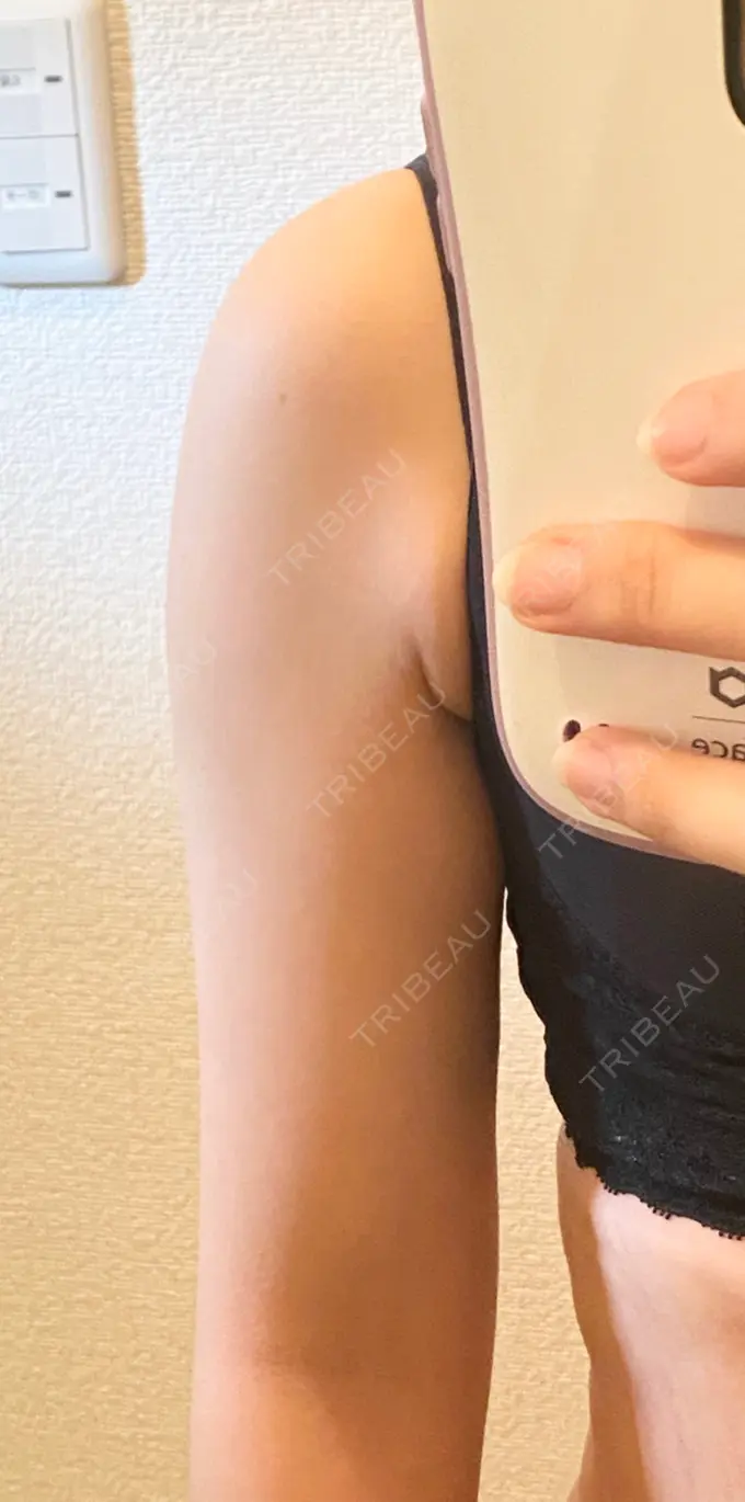 脂肪吸引（二の腕） 広島プルミエクリニック DAY 77 メイン用