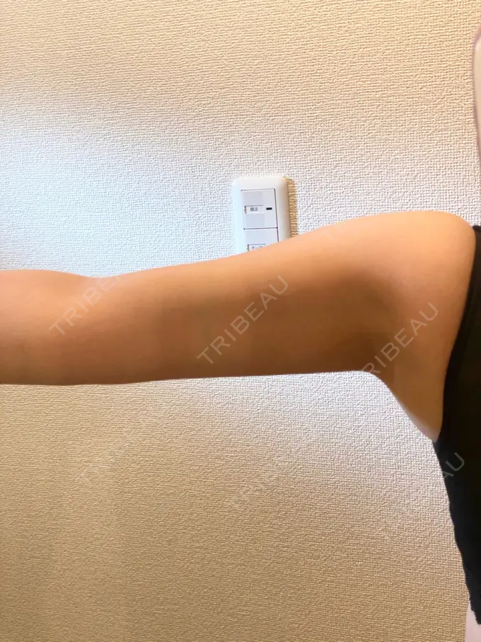 脂肪吸引（二の腕） 広島プルミエクリニック DAY 77 メイン用