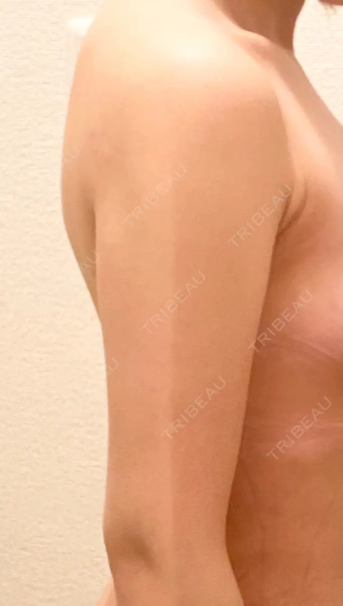 脂肪吸引（二の腕） 広島プルミエクリニック DAY 94 メイン用