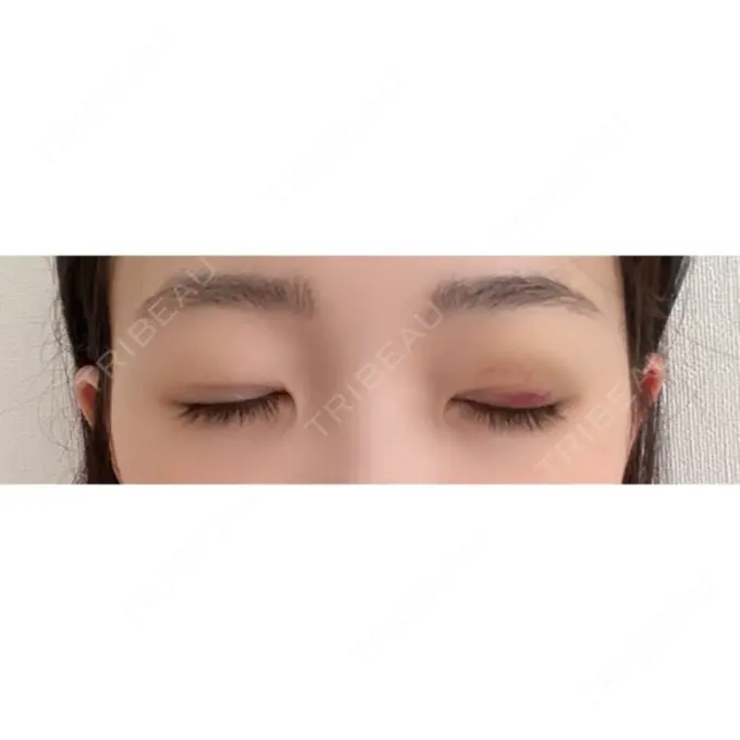 二重埋没 湘南美容クリニック 東京蒲田院 DAY 5 メイン用