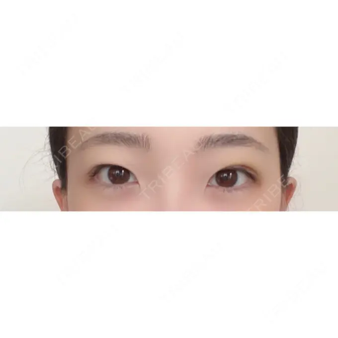 二重埋没 湘南美容クリニック 東京蒲田院 DAY 6 メイン用