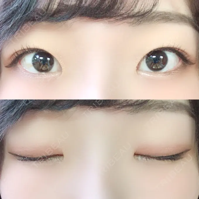 二重埋没 / 上まぶたの脂肪取り いわきタウン形成外科クリニック DAY 93 メイン用