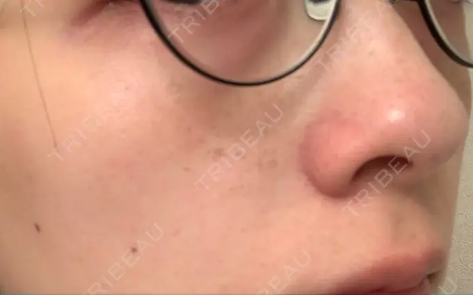 シミ取りレーザー / 美白レーザー よつば会クリニック 森ノ宮院 DAY 9 メイン用