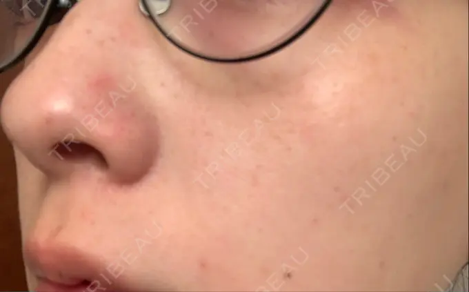 シミ取りレーザー / 美白レーザー よつば会クリニック 森ノ宮院 DAY 9 メイン用