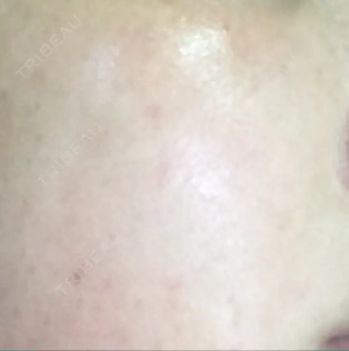 ほくろ・いぼ切除（肌） / ほくろ・いぼ除去レーザー（肌） / 美白レーザー / YAGレーザー REYOUNGクリニック AFTER メイン用