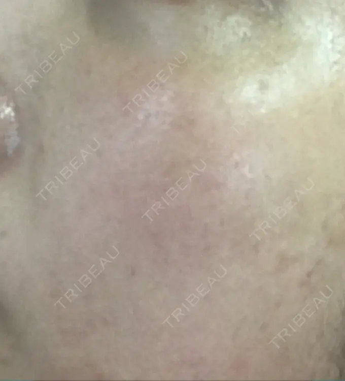 ほくろ・いぼ切除（肌） / ほくろ・いぼ除去レーザー（肌） / 美白レーザー / YAGレーザー REYOUNGクリニック DAY 16 メイン用