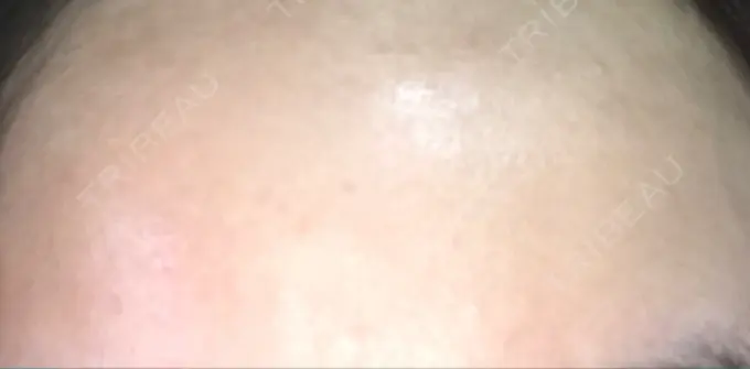 ほくろ・いぼ切除（肌） / ほくろ・いぼ除去レーザー（肌） / 美白レーザー / YAGレーザー REYOUNGクリニック DAY 16 メイン用