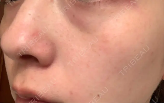 シミ取りレーザー / 美白レーザー よつば会クリニック 森ノ宮院 DAY 10 メイン用