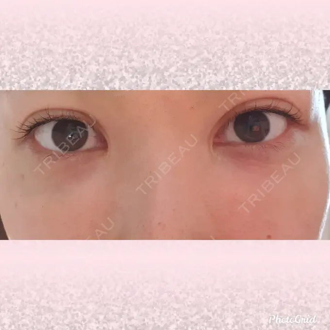 シワ取りボトックス CLASSY 仙台美容外科・美容皮膚科 DAY 14 メイン用