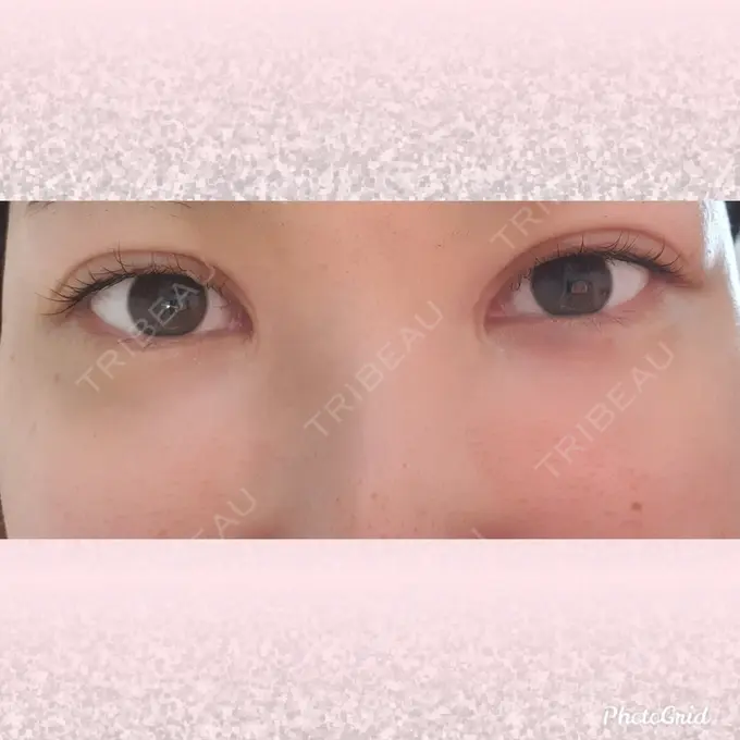 シワ取りボトックス CLASSY 仙台美容外科・美容皮膚科 DAY 14 メイン用