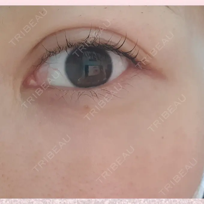 シワ取りボトックス CLASSY 仙台美容外科・美容皮膚科 DAY 14 メイン用