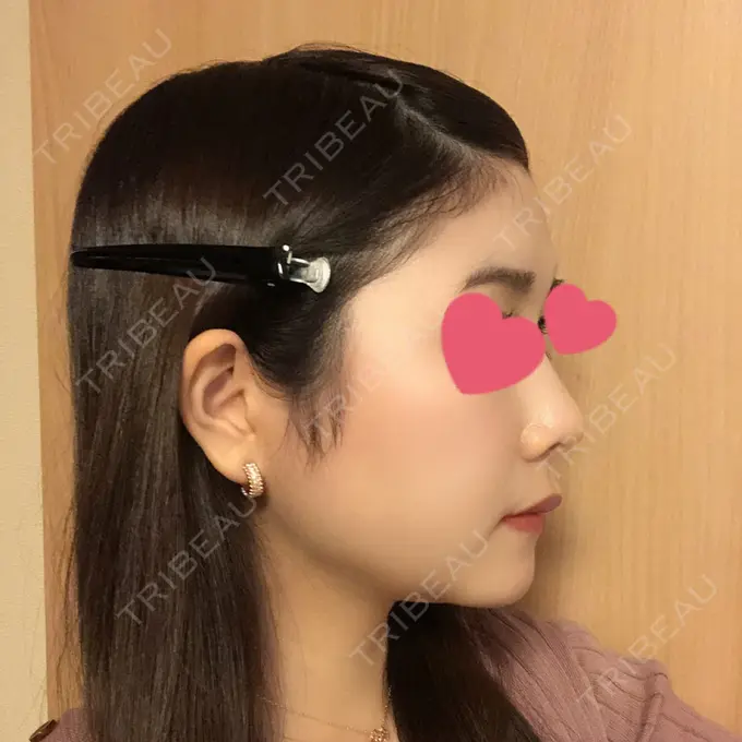 糸リフト / 骨切り（あご） / 骨削り（頬） / 脂肪吸引（顔） RG整形外科（旧リオン整形外科） DAY 105 メイン用