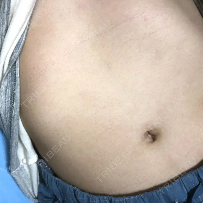 その他（ボディ） 船橋中央クリニック DAY 10 メイン用