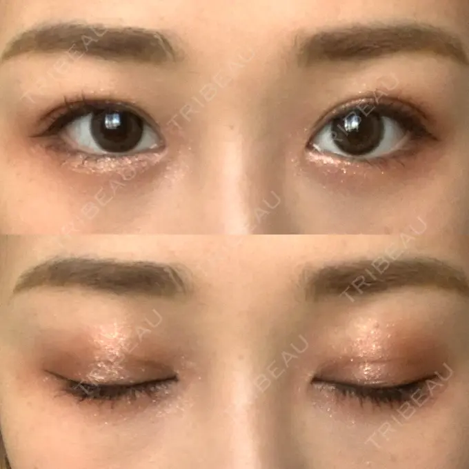 二重埋没 湘南美容クリニック 西宮北口院 DAY 24 メイン用