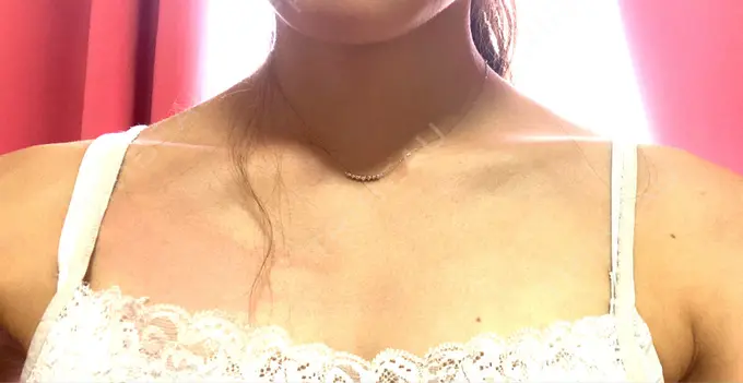 ボトックス（肩） TCB東京中央美容外科 中野院 AFTER メイン用