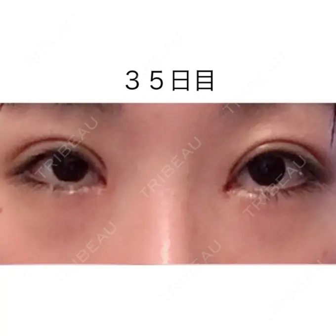 二重切開 / 目頭切開 / 眼瞼下垂（切開） / 目尻切開 / タレ目形成・グラマラスライン（切開） ジュエリー美容外科 DAY 34 メイン用