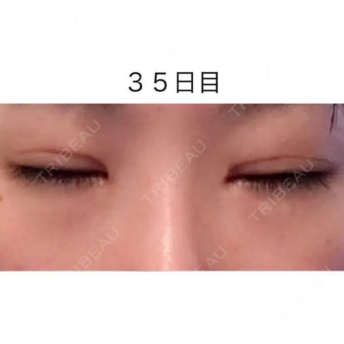 二重切開 / 目頭切開 / 眼瞼下垂（切開） / 目尻切開 / タレ目形成・グラマラスライン（切開） ジュエリー美容外科 DAY 34 メイン用