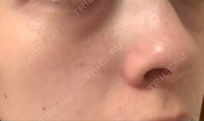 シミ取りレーザー / 美白レーザー よつば会クリニック 森ノ宮院 DAY 12 メイン用