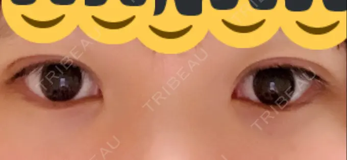 二重埋没 品川スキンクリニック広島院 DAY 6 メイン用