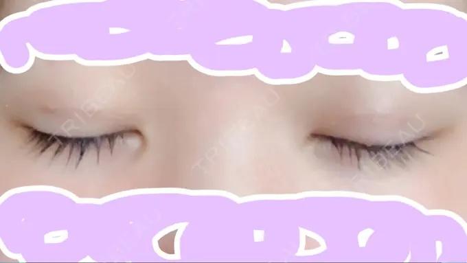 二重埋没 品川スキンクリニック広島院 DAY 7 メイン用