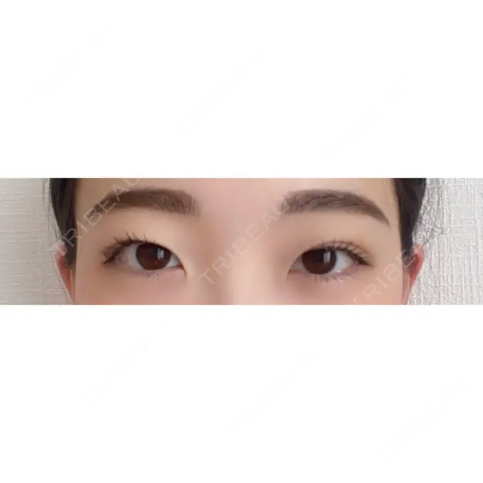 二重埋没 湘南美容クリニック 東京蒲田院 AFTER メイン用