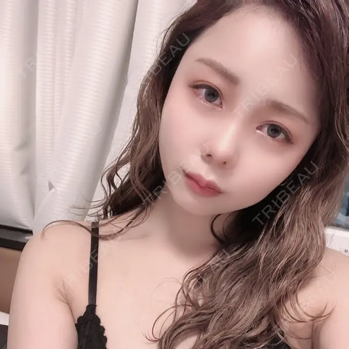 二重埋没 / 目頭切開 ドクター松井クリニック 新宿 DAY 81 メイン用