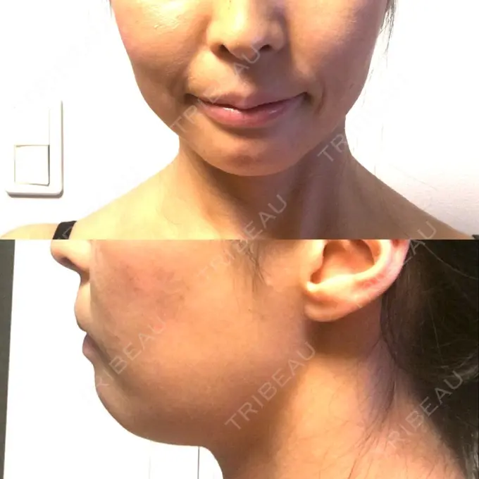 あごプロテーゼ ティーズクリニック DAY 15 メイン用