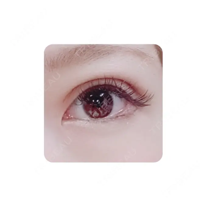 二重切開 カリスクリニック DAY 35 メイン用