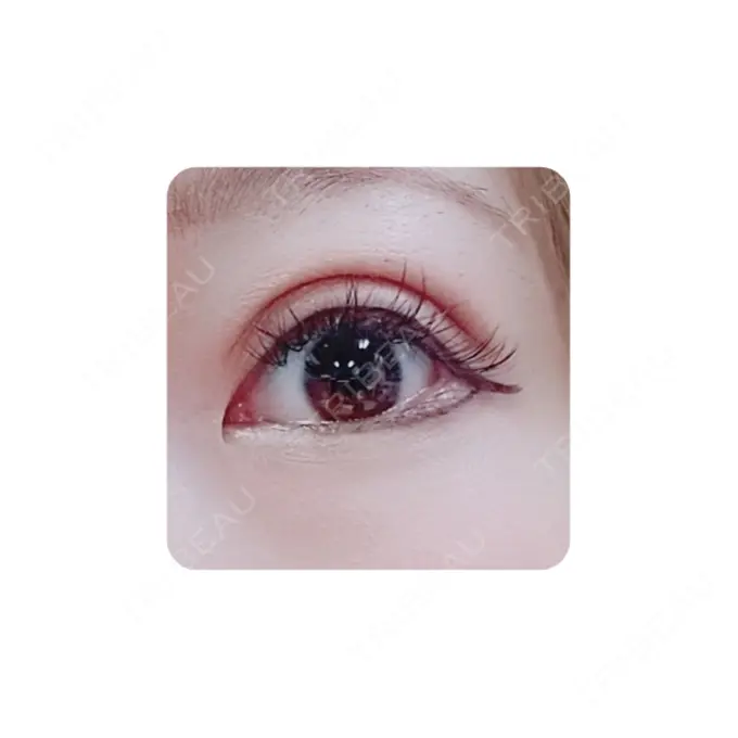 二重切開 カリスクリニック DAY 36 メイン用