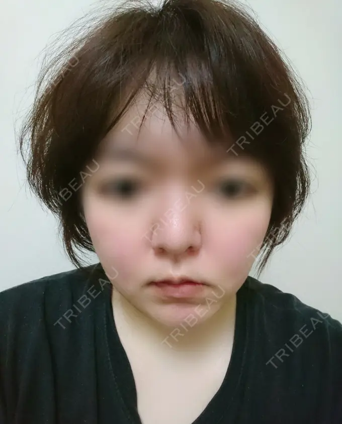 脂肪冷却（輪郭） 湘南美容クリニック 町田院 AFTER メイン用