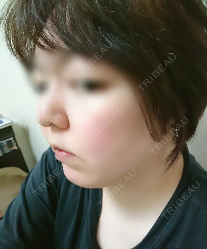 脂肪冷却（輪郭） 湘南美容クリニック 町田院 DAY 31 メイン用