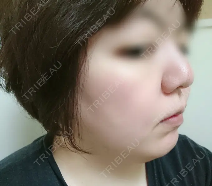 脂肪冷却（輪郭） 湘南美容クリニック 町田院 DAY 31 メイン用