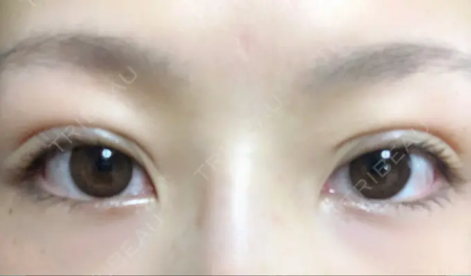 二重埋没 湘南美容クリニック 福島院 DAY 21 メイン用