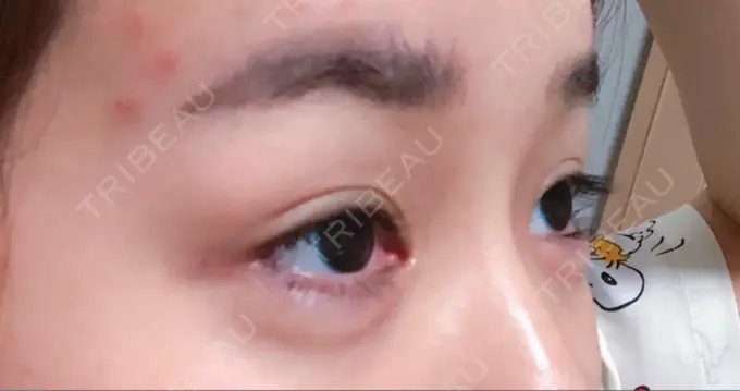 二重切開 / 目頭切開 / 眼瞼下垂（切開） / 目尻切開 / タレ目形成・グラマラスライン（切開） / 前額リフト F5整形外科 DAY 90 メイン用