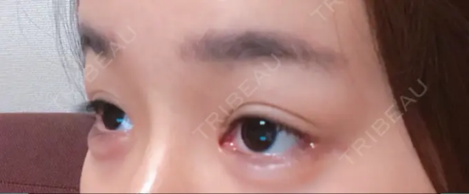 二重切開 / 目頭切開 / 眼瞼下垂（切開） / 目尻切開 / タレ目形成・グラマラスライン（切開） / 前額リフト F5整形外科 DAY 90 メイン用