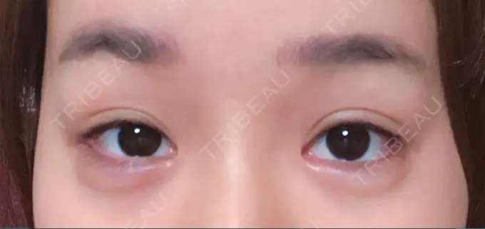 二重切開 / 目頭切開 / 眼瞼下垂（切開） / 目尻切開 / タレ目形成・グラマラスライン（切開） / 前額リフト F5整形外科 DAY 90 メイン用