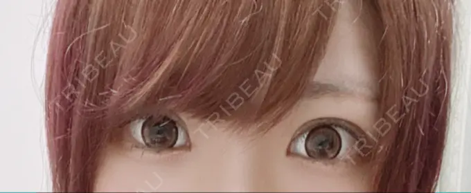 眼瞼下垂（切開） / 上まぶたの脂肪取り なでしこクリニック DAY 288 メイン用