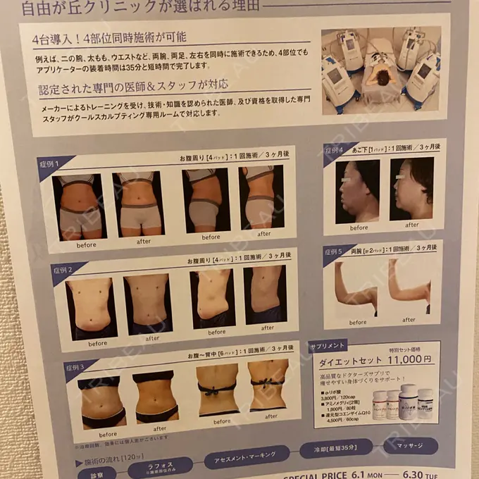 毛穴洗浄（ハイドラフェイシャルなど） 自由が丘クリニック DAY 0 メイン用