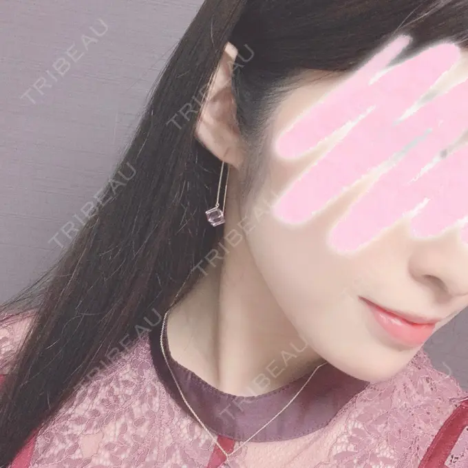 ボトックス（口角） / ハイフ（顔） Original Beauty Clinic GINZA DAY 0 メイン用