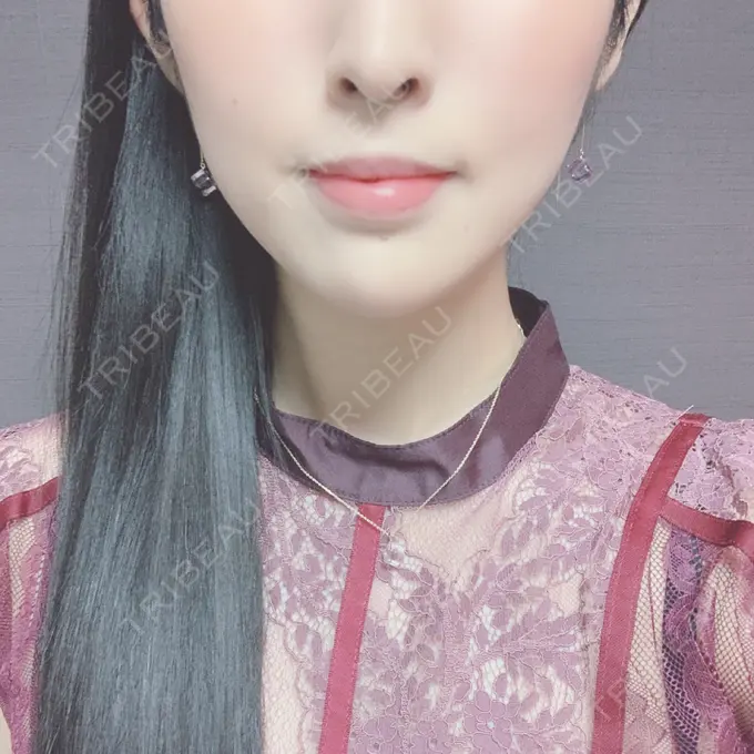 ボトックス（口角） / ハイフ（顔） Original Beauty Clinic GINZA DAY 0 メイン用