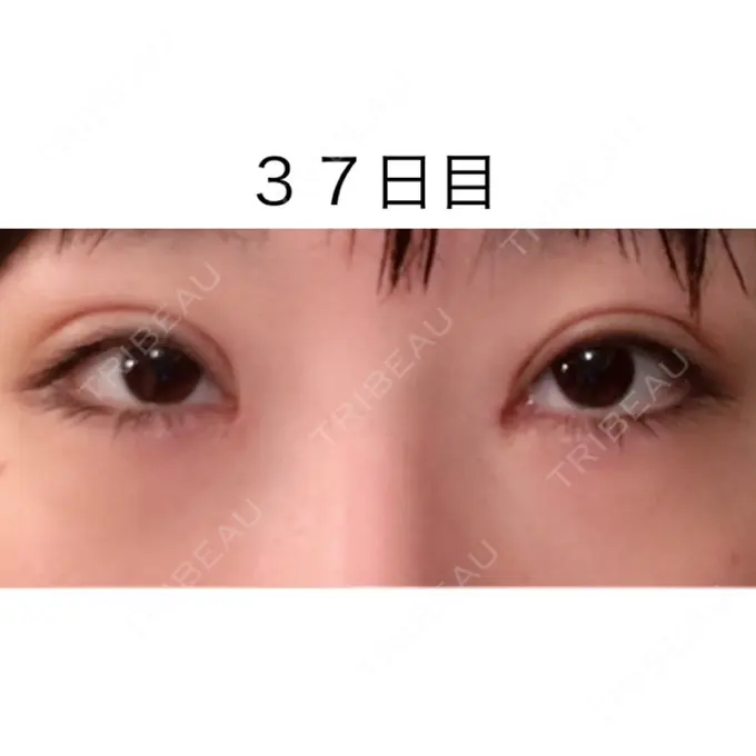 二重切開 / 目頭切開 / 眼瞼下垂（切開） / 目尻切開 / タレ目形成・グラマラスライン（切開） ジュエリー美容外科 DAY 36 メイン用
