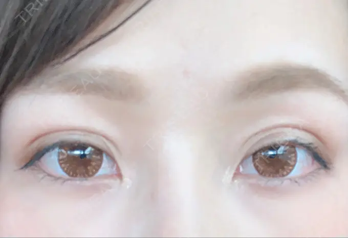 二重埋没 湘南美容クリニック 福島院 DAY 24 メイン用