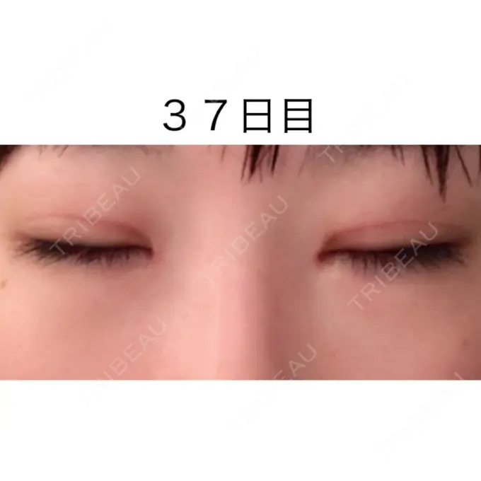 二重切開 / 目頭切開 / 眼瞼下垂（切開） / 目尻切開 / タレ目形成・グラマラスライン（切開） ジュエリー美容外科 DAY 36 メイン用