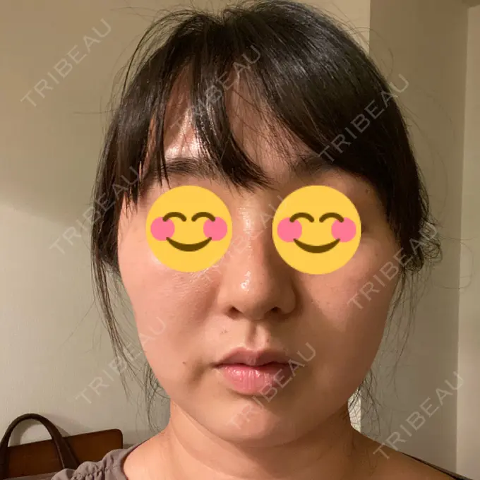 毛穴洗浄（ハイドラフェイシャルなど） 自由が丘クリニック AFTER メイン用